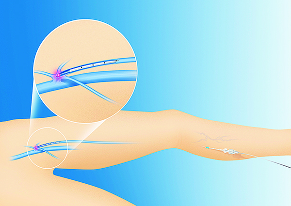「下肢静脈瘤血管内レーザー治療」は、大伏在静脈と大腿静脈の合流部までレーザーを導き、下方に牽引してレーザーを照射（イメージ）