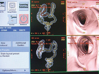 CTコロノグラフィー 　当院では直腸・大腸の検査の1つとして「CTコロノグラフィー」を導入しています。この検査は内視鏡を用いず、CTで腸内部の立体画像を作成し、診断に用います。主に、腸が長い・癒着がある、内視鏡で苦痛がある方で使用します。 　このほか「CTコロノグラフィー」による大腸がんドック（自由診療、2万7000円）も実施しています。