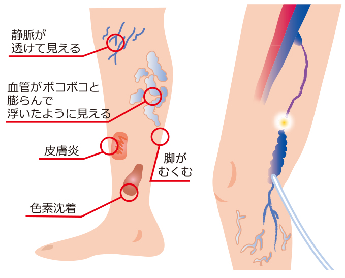 左：下肢静脈瘤の症状（イメージ）、右：患部にレーザーファイバーを挿入する治療のイメージ